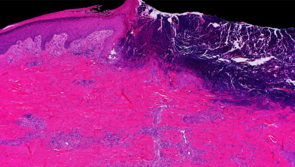 Mayo Clinic Wound Symposium: The Edges of Wound Care 2022