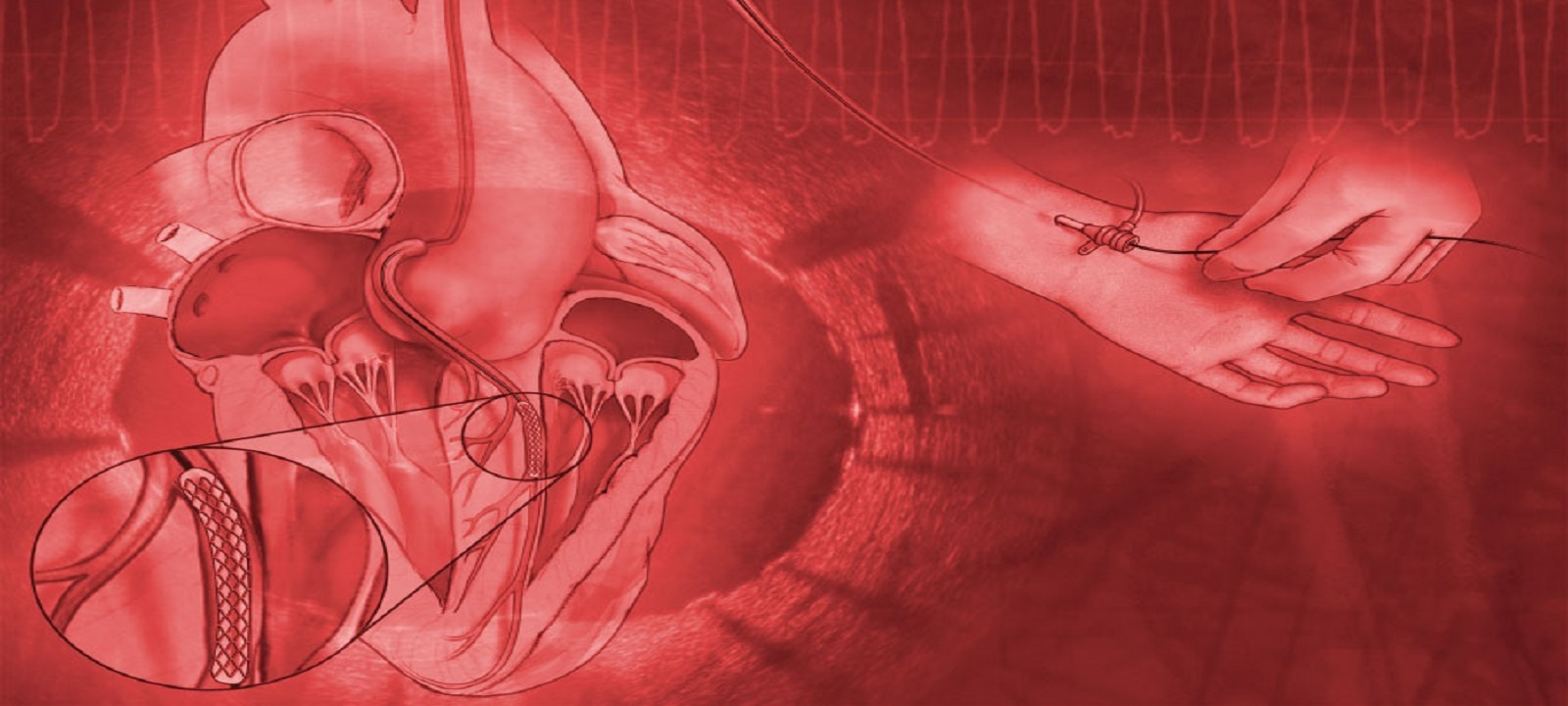 Interventional Cardiology Review Course for Boards and Recertification- Livestream CME