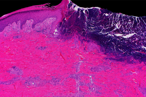 Mayo Clinic Wound Symposium: The Edges of Wound Care 2022