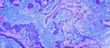 Scripps Annual Melanoma Cutaneous Malignancy CME Update 2022